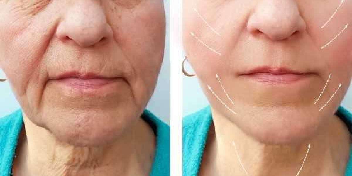 Botox: More Than Just a Wrinkle Fixer: Find Out How