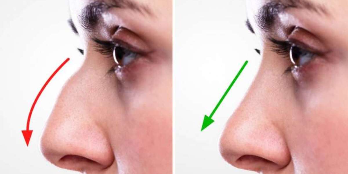 Patient Reviews Reveal Where to Get the Best Rhinoplasty in Islamabad