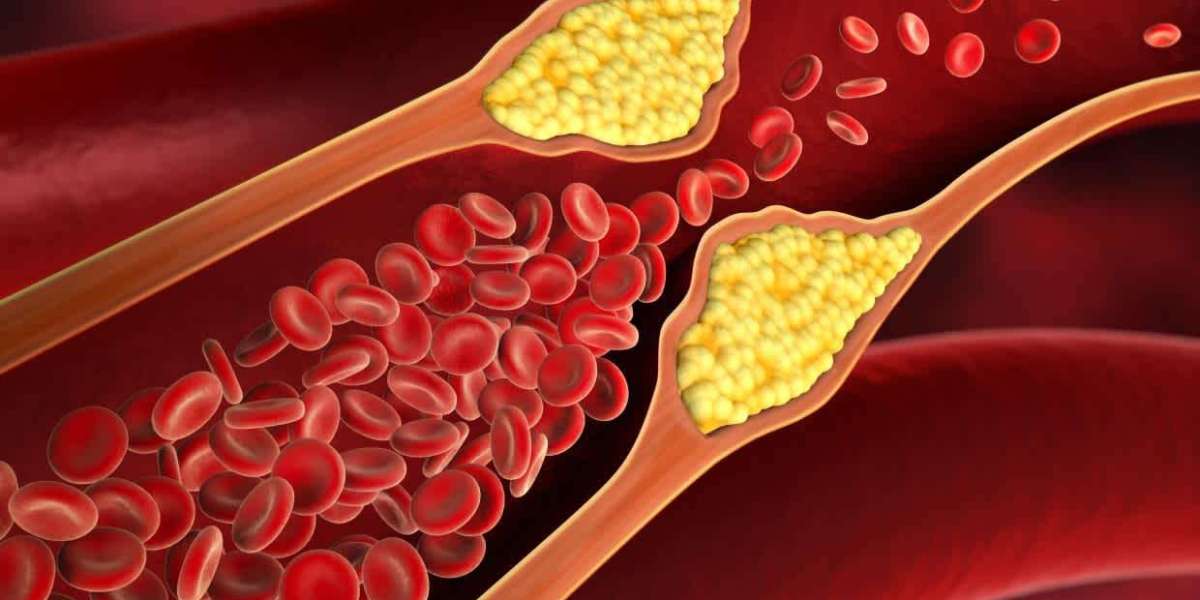 High Cholesterol: Causes, Symptoms, and How It Affects the Body