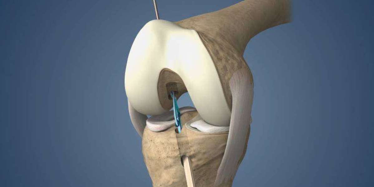 ACL, MCL, or PCL – Which Ligament Injury Needs Surgery? Insights from the Best Ligament Surgeon in Delhi