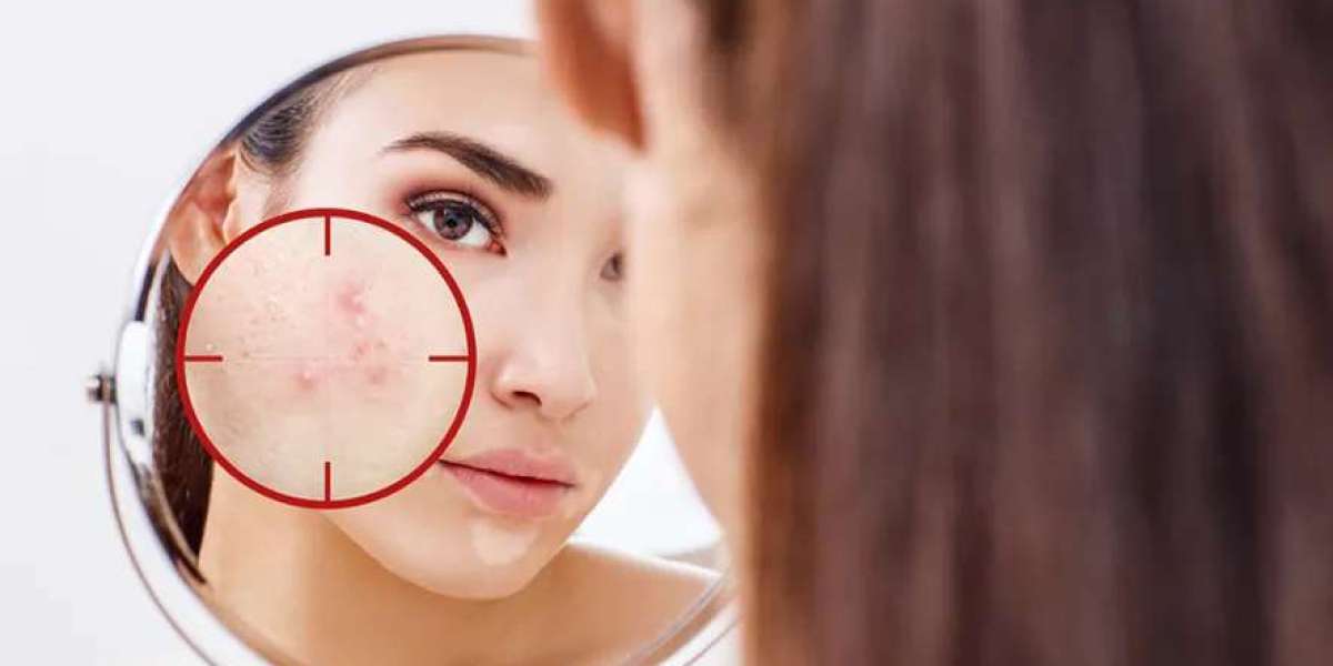 How Laser Acne Scar Removal in Singapore Improves Skin Safely