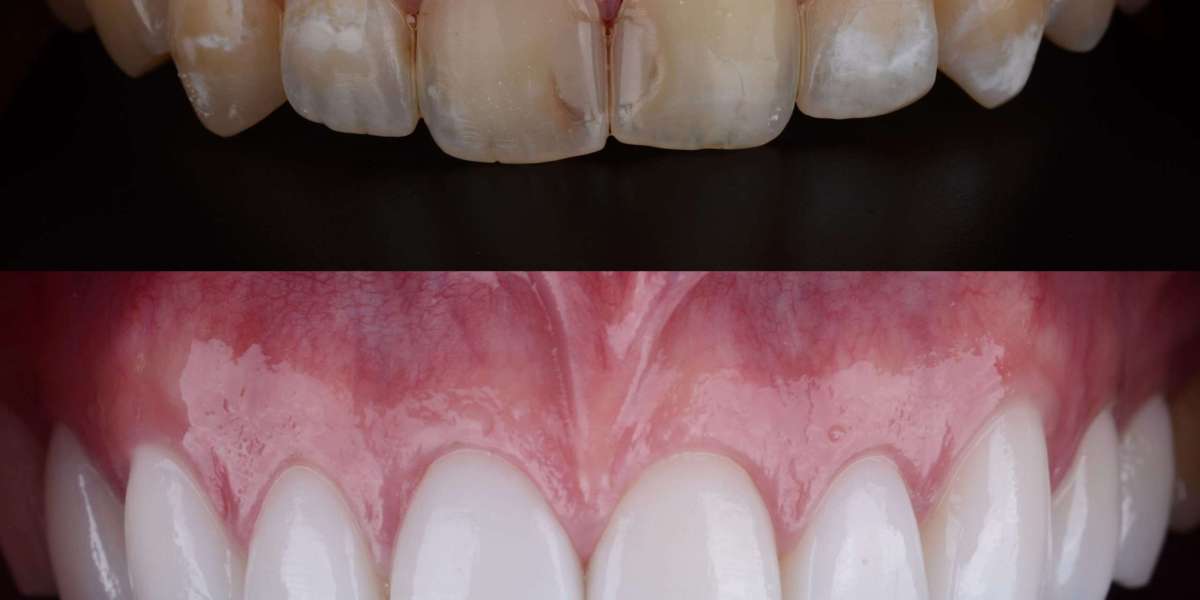 Whitening Treatments That Actually Work: Expert Recommendations