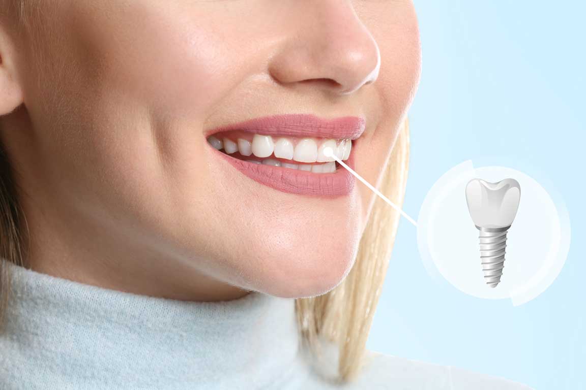 How to Check If Your Insurance Covers Dental Implants: A Step-by-Step Guide – BDnews55.com