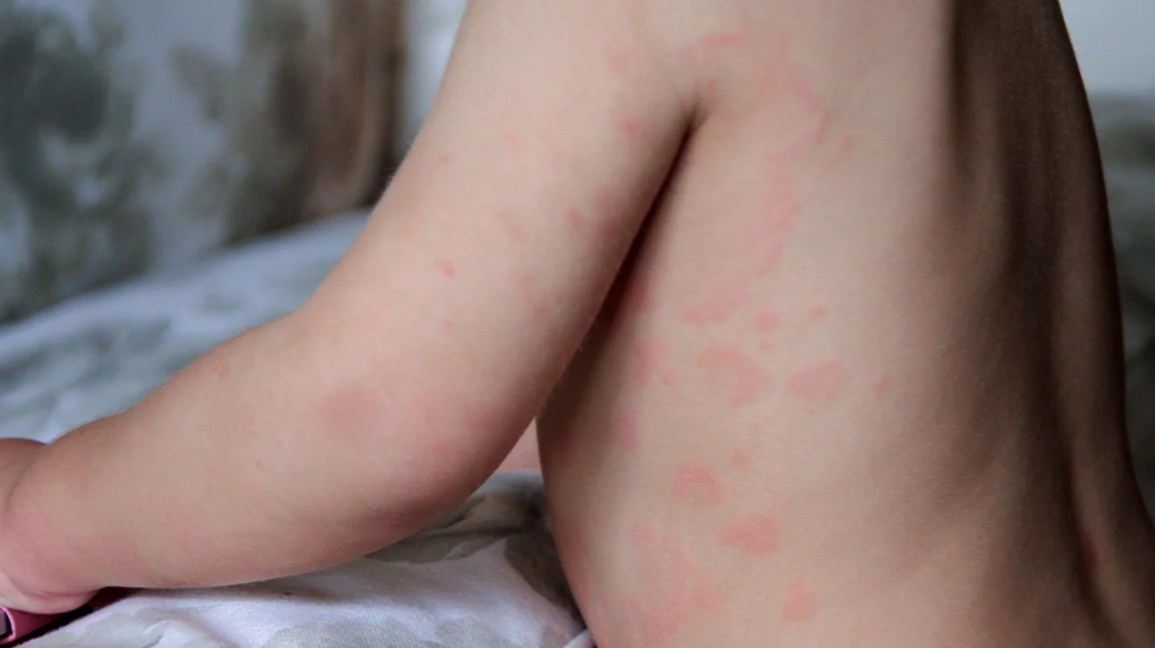 What Causes Hives in Children: Causes and Treatment Options – Telegraph