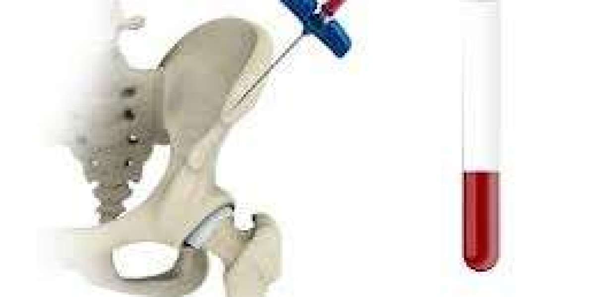 Bone Marrow Aspirate Concentrates Market Technology: Innovations Driving Adoption