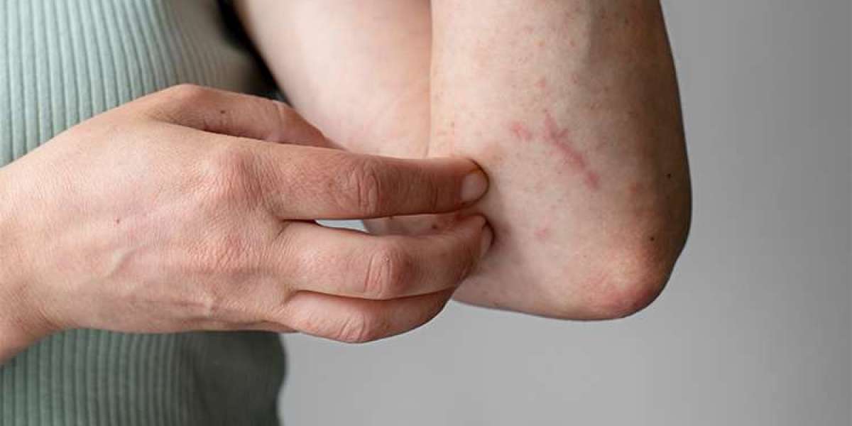 What to Do If You Have Recurrent Fungal Infections - Best Dermatologist in Ludhiana