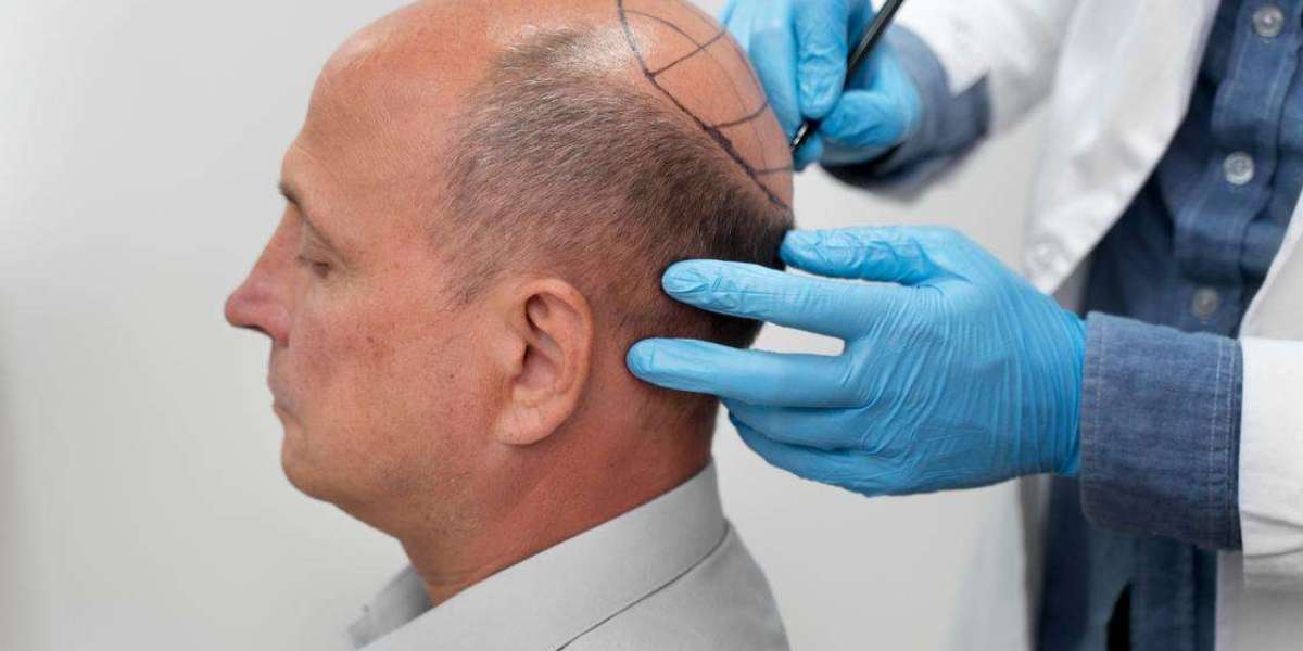 Reclaim Your Hair and Confidence with a Modern Hair Transplant in Islamabad